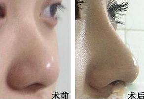 大鼻子可以打玻尿酸缩小吗