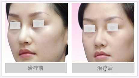 鼻头肥大自然缩小图片