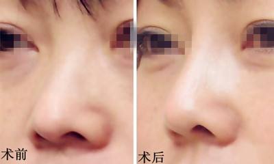 膨体太高可以变矮么