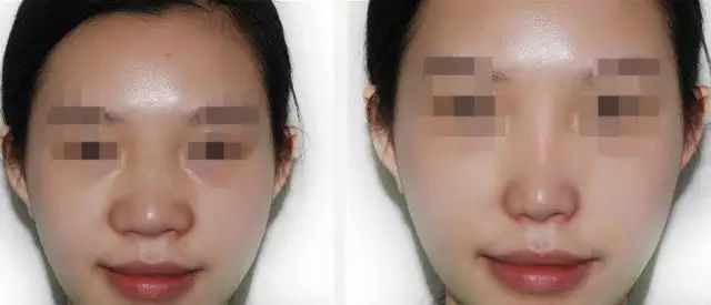 鼻翼鼻头缩小图片