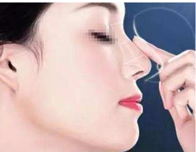 鼻部手术鼻头多久能消肿
