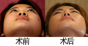 鼻孔太大怎么办 如何缩小鼻孔