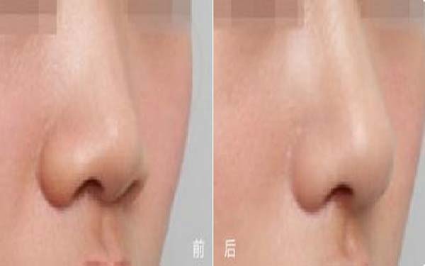 缩小鼻翼