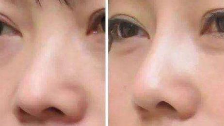 有关鼻头肥大矫正术后护理