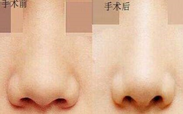 缩小鼻翼有什么风险