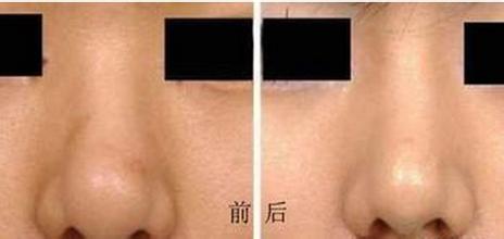 缩小鼻翼的方法