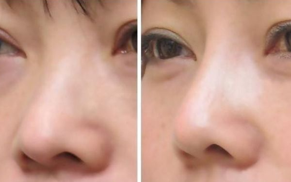 临沂做鼻头缩小多少钱