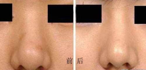 鼻头缩小微创的后遗症有哪些