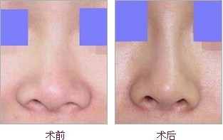 鼻头很大很圆怎么办