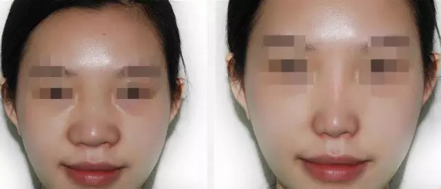 做缩鼻翼手术多少钱