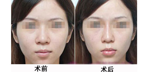 缩小鼻头手术多久恢复
