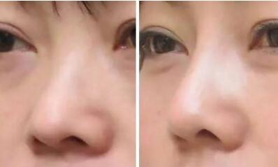 做鼻头缩小手术要了解的知识