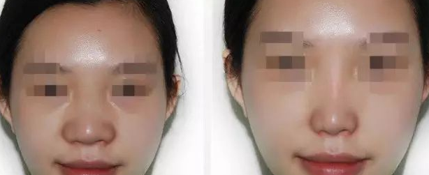 鼻头鼻翼缩小对比图