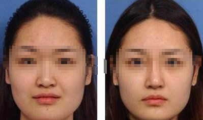 鼻头肥大怎么缩小比较好看？