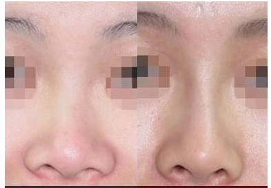 鼻头肥大要怎么办？