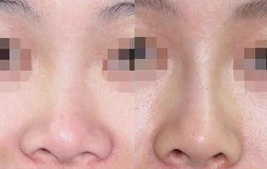 鼻头缩小的过程你知道吗？
