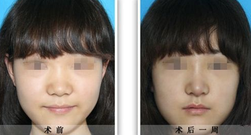 鼻头缩小术的手术过程，术后如何护理