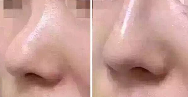 鼻头缩小术多久恢复过程如何