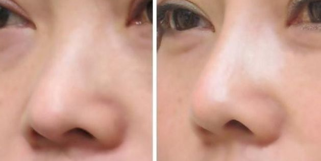 鼻头整形的价格及副作用有哪些