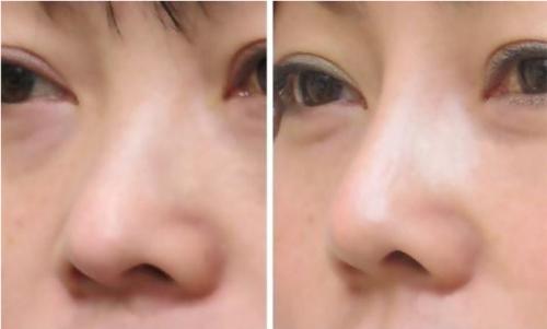 鼻头特大缩小多少钱