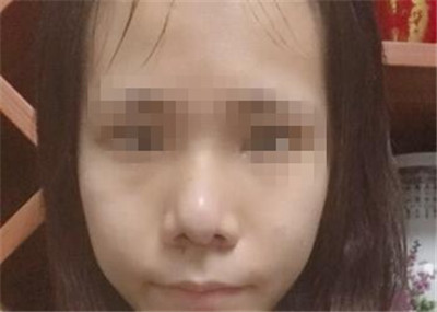 鼻部缩小鼻头手术恢复日记