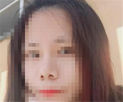鼻部缩小鼻头手术恢复日记