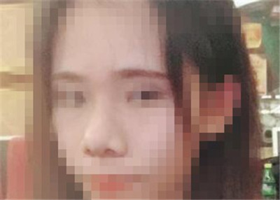 鼻部缩小鼻头手术恢复日记