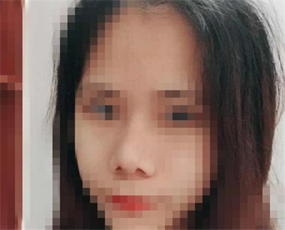 鼻部缩小鼻头手术恢复日记