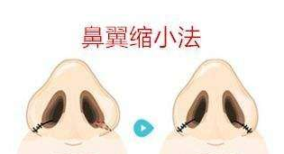 哪里做鼻翼缩小好