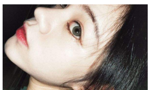 缩小鼻翼手术的方法有哪些