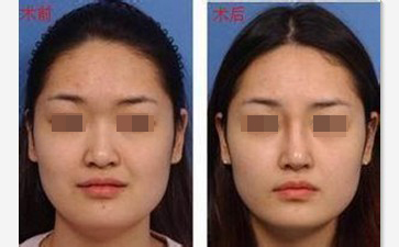 鼻翼缩小保持永久吗