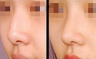 不手术有哪些方法缩小鼻翼