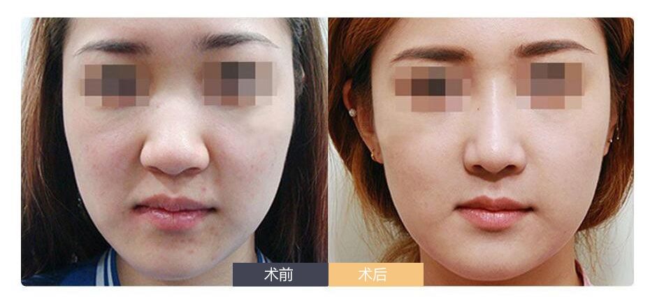 鼻翼缩小术前还需注意哪些