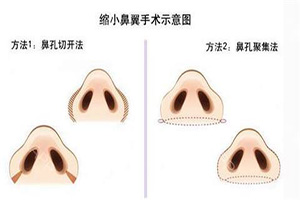 鼻头、鼻翼肥大怎样做？