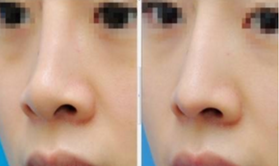 北京鼻翼缩小术后3个月才呈现效果吗 