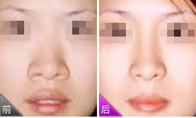 鼻尖肉多圆圆可以做鼻尖缩小手术吗