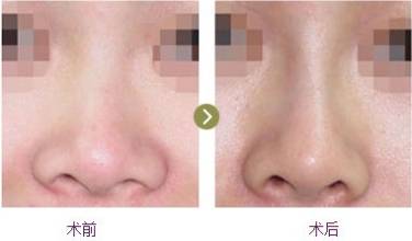 鼻翼缩小手术做了后悔怎么办