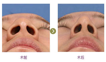 鼻翼缩小手术后日记图