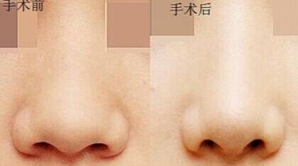整容缩鼻翼多少钱