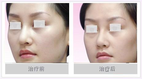 缩小鼻翼需要垫假体吗