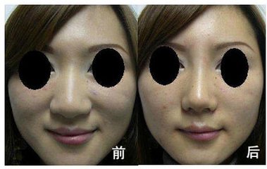 缩小鼻翼后遗症图