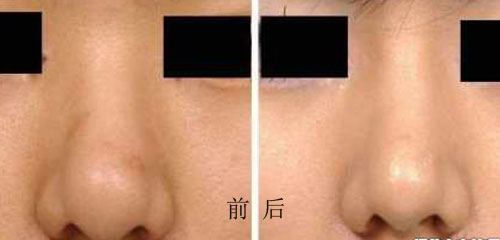 鼻翼缩小手术后对比图