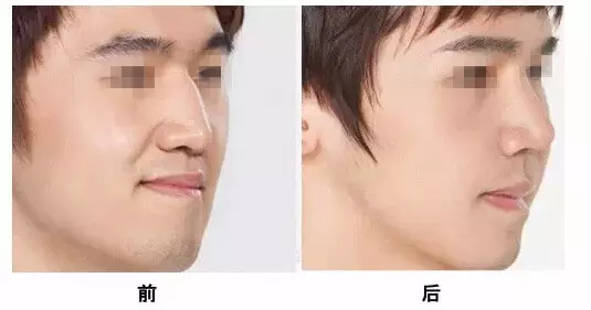 鼻子特别大能整形小吗?