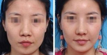 缩鼻翼什么时候恢复