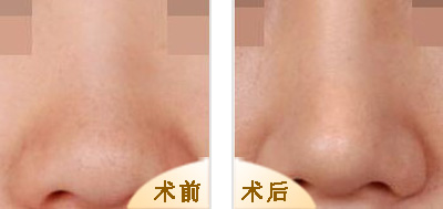 做鼻翼缩小手术效果好不好？