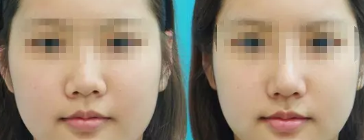 常见的鼻翼缩小手术方法