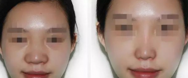 改善鼻翼肥大有哪些方法