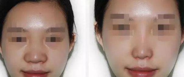 改善鼻翼肥大有哪些方法
