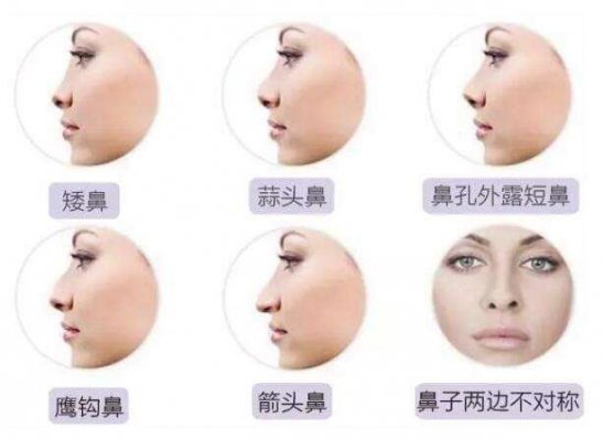 不同形态鼻型做鼻翼缩小术的方式