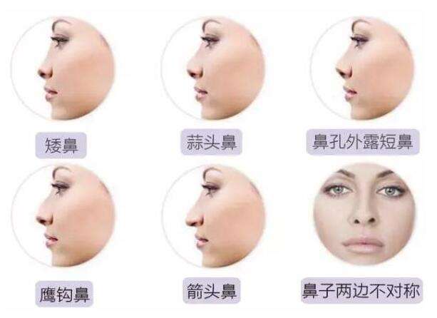 不同形态鼻型做鼻翼缩小术的方式